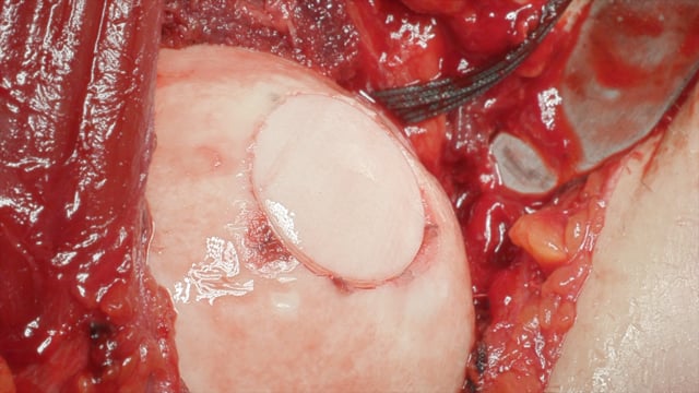 Humeral Head Osteochondral Allograft Transplantation for a Contained Humeral Head Defect