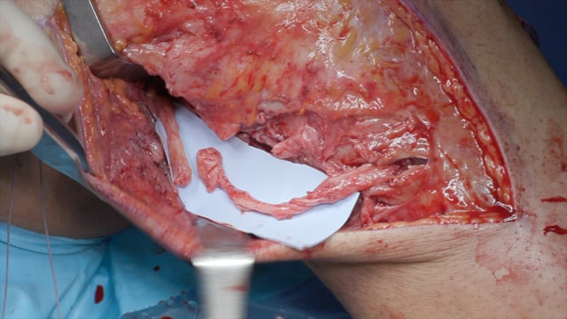 Multiligament Knee Injury with Common Peroneal Nerve Rupture – Single-Stage ACL and PLC Reconstruction and CPN Graft