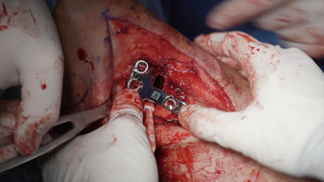 Combined Meniscus Allograft Transplant and High Tibial Osteotomy Using Patient Specific Instrumentation