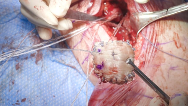 Anterior Capsule Reconstruction (ACR) for Subscapularis Insufficiency after Total Shoulder Arthroplasty