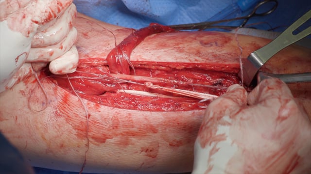 Rectus Femoris Musculotendinous Junction Reconstruction with Semitendinosus Autograft and Achilles Allograft