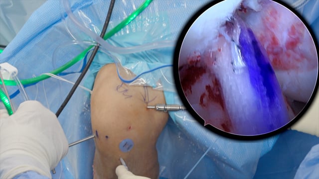 ACL Repair with BioBrace Augmentation and BEAR Implant