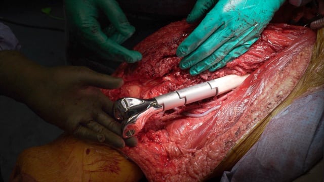 Sub-Total Femoral Resection, Vascular Dissection, and Reconstruction for Parosteal Osteosarcoma