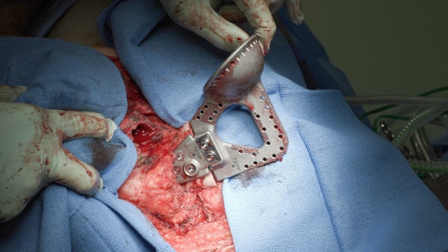 Custom-Made Scapula and Shoulder Replacement After Subtotal Scapulectomy