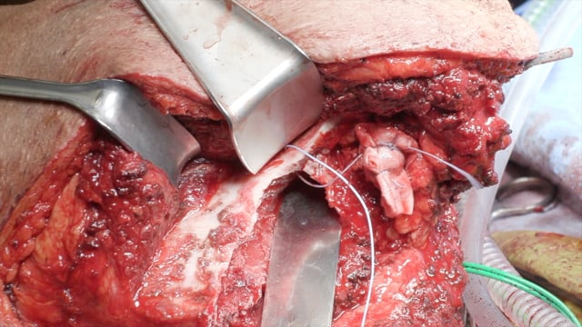 Partial Scapulectomy for Secondary Chondrosarcoma