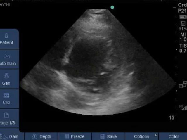 Ultrasonography - Inferoposterior Wall Motion Abnormality on Vimeo