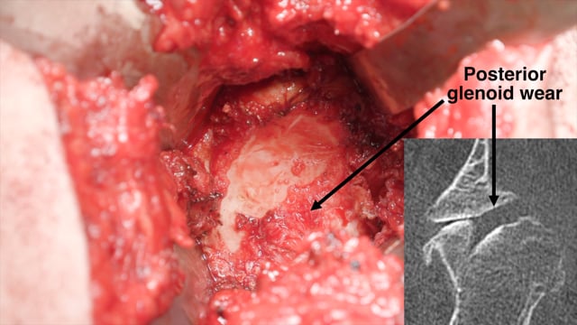 Reverse Total Shoulder Arthroplasty for Post-Traumatic Arthritis in a Patient with Obstetric Erb’s Palsy