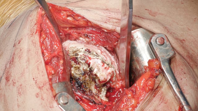 Reverse Total Shoulder Arthroplasty: Treatment of Chronic Anterior Glenohumeral Dislocation