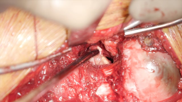 Surgical Hip Dislocation for Excision of Pigmented Villonodular Synovitis (PVNS)