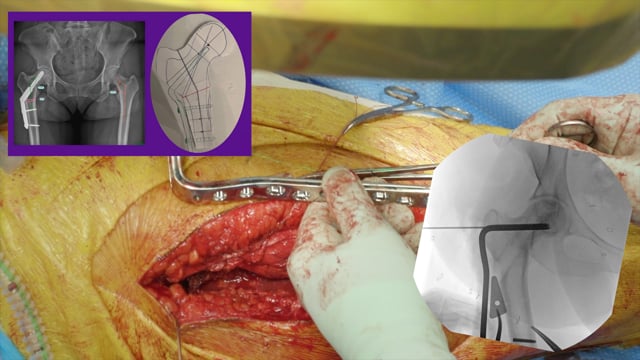 Proximal Femoral Osteotomy for a Varus Femoral Neck Malunion
