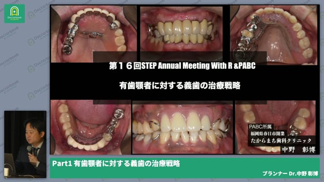 有歯顎者に対する義歯の戦略 -イントロ- 中野 彰博先生