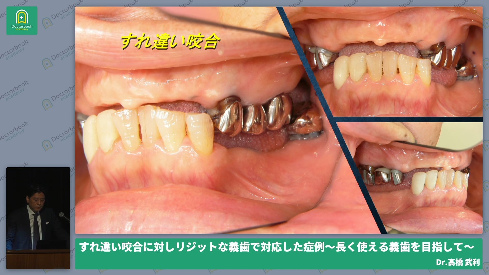 すれ違い咬合に対しリジットな義歯で対応した症例 〜長く使える義歯を目指して〜 髙橋 武利先生