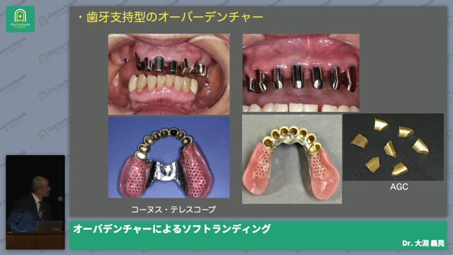 オーバーデンチャーによるソフトランディング 大淵善晃先生