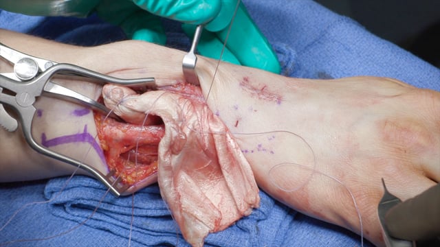 Achilles Tendon Interposition Allograft for Treatment of Post-Traumatic Deformity of the Ulnar Head with Distal Radioulnar Joint Arthritis and Instability