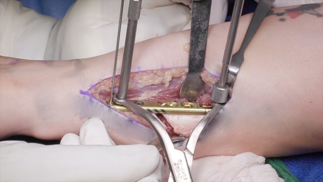 Surgical Repair of Essex-Lopresti Injury