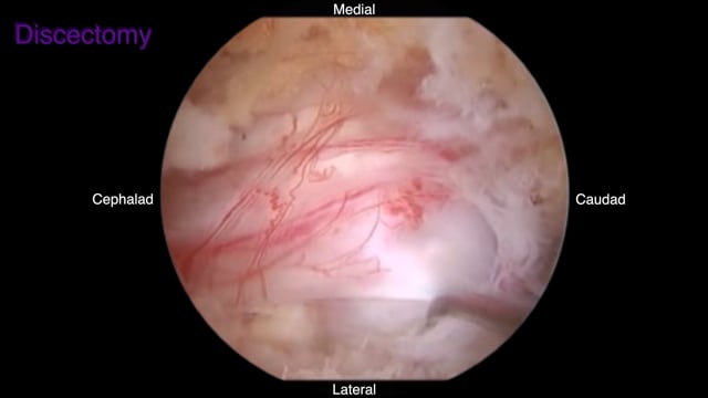 Dual-Portal Endoscopic Lumbar Discectomy