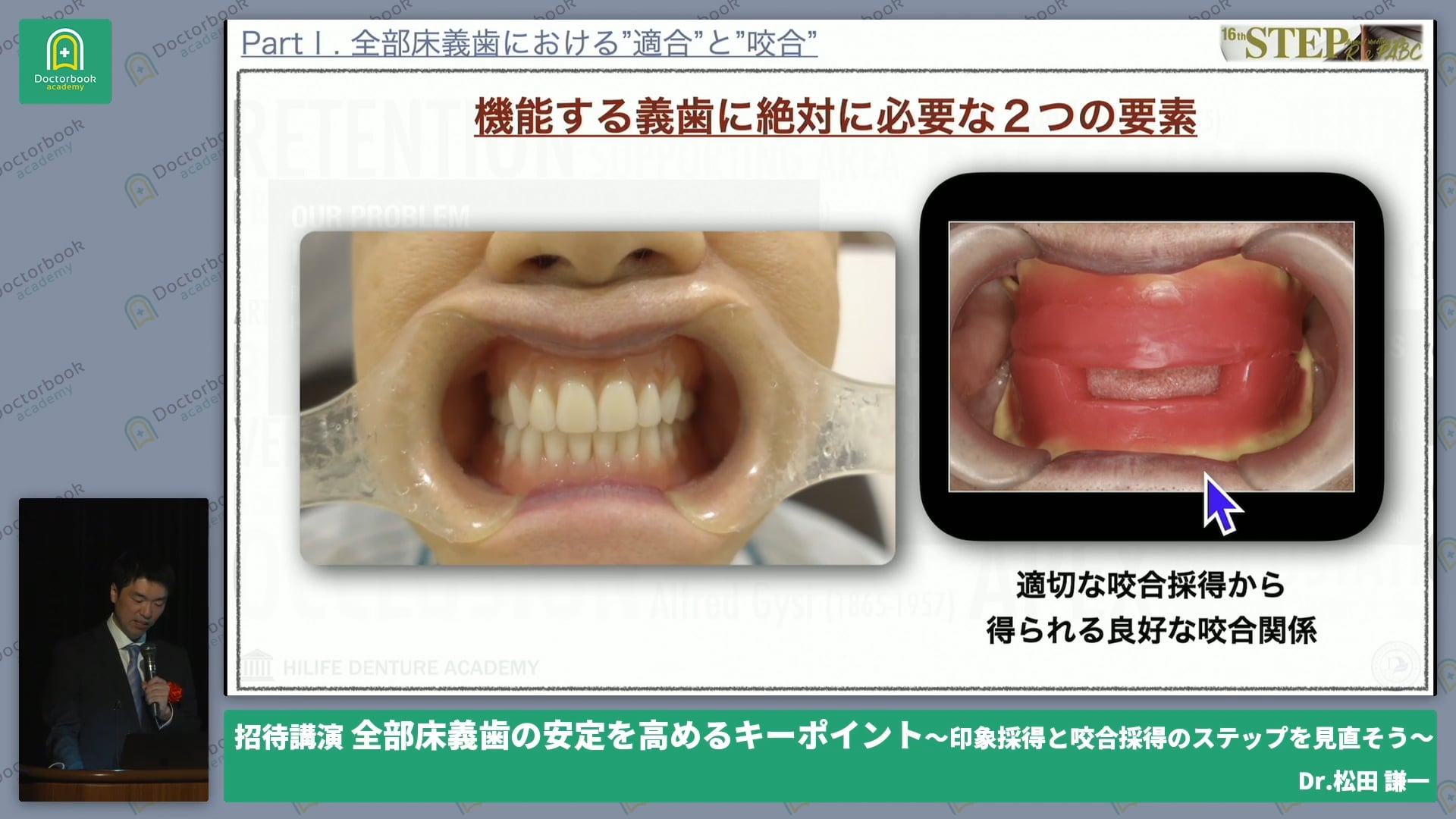 全部床義歯の安定を高めるキーポイント 〜印象採得と咬合採得のステップを見直そう〜