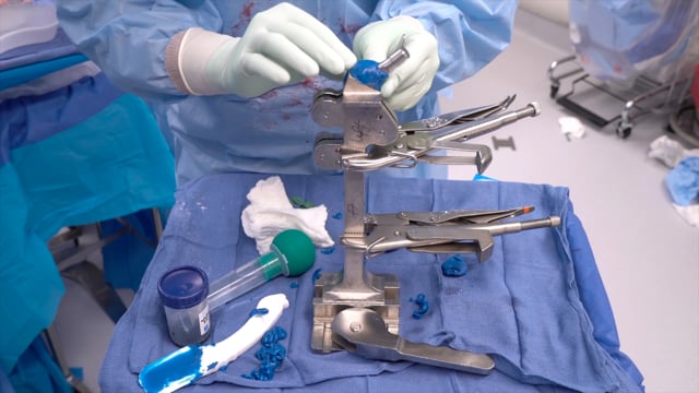 Articulating Hip Spacer Preparation – Prostalac Hip System