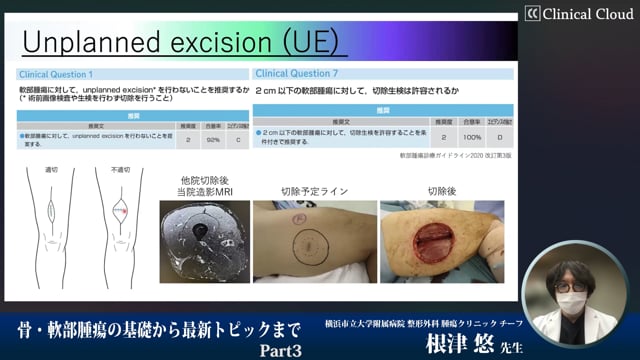 骨・軟部腫瘍の基礎から最新トピックまでPart3-骨軟部腫瘍における放射線治療と術後合併症-