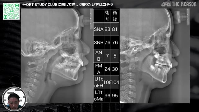 第23回 鼻呼吸障害と発達への影響に着目した症例報告