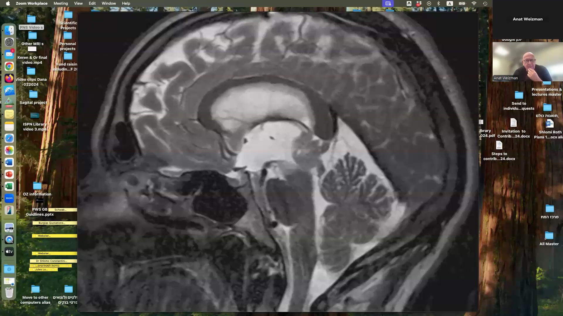 Combined Rigid and Flexible Endoscopy for Pineal Region Tumor
