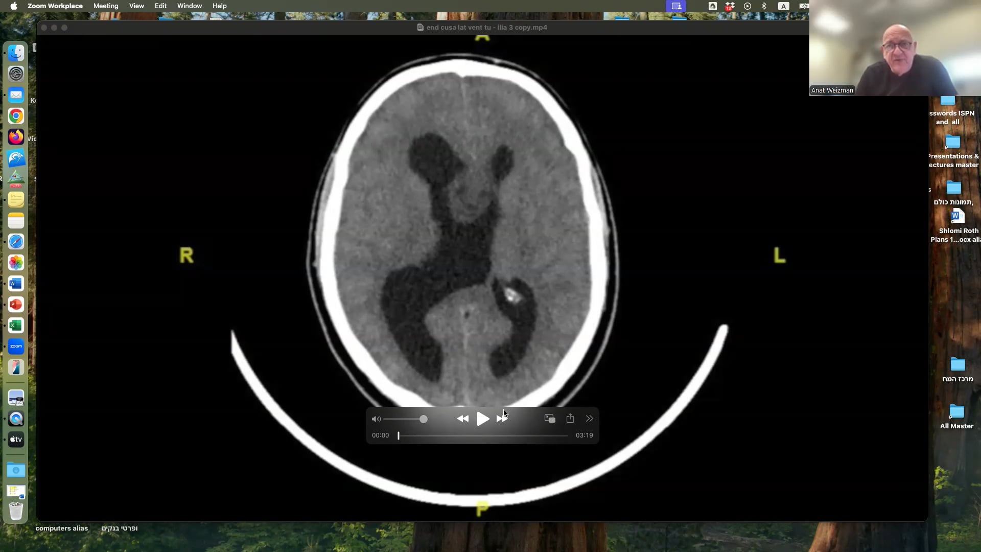 Endoscopic Removal Of Intraventricular Tumor Using an Endoscopic CUSA