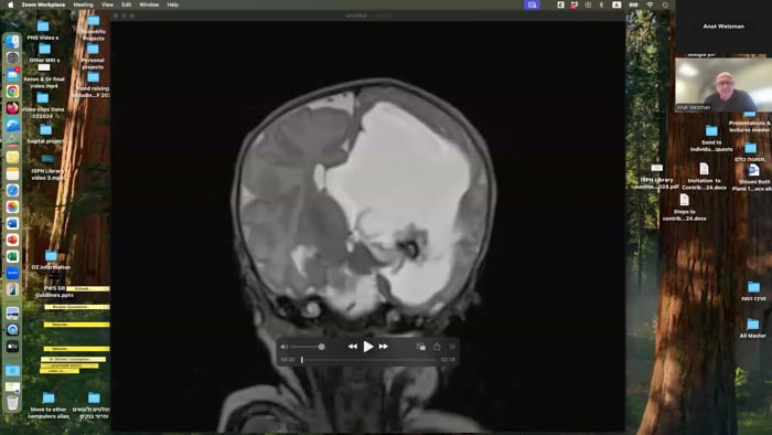 Neuroendoscopy for Intraventricular Cyst