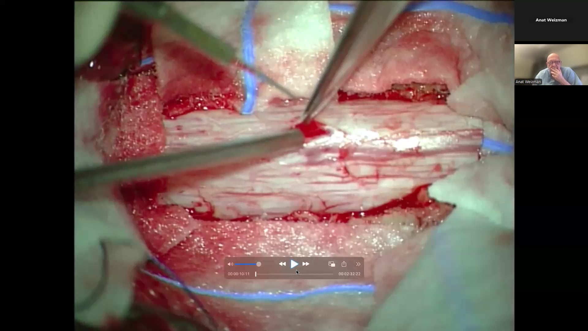 Removal Of Intramedullary Ependymoma