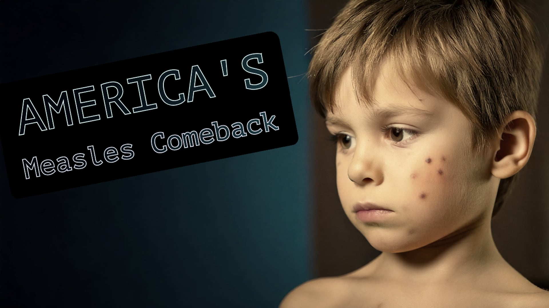 America's Measles Comeback