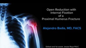 Dr Badia Performs an Open Reduction with Internal Fixation of a Proximal Humerus Fracture