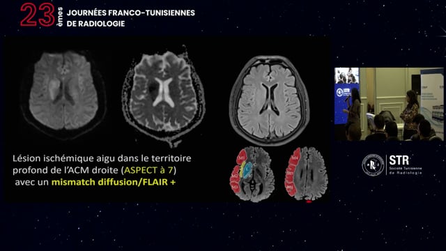 Thrombectomie mécanique (atelier sur simulateur)