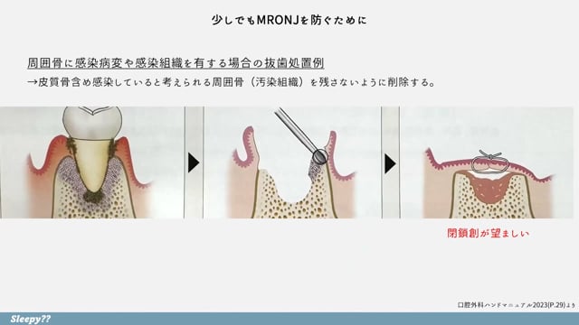 骨吸収抑制薬を服用している患者への対応 #2