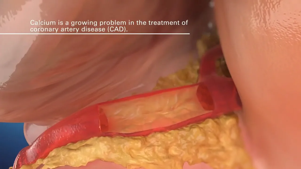 ROTAPRO™ Rotational Atherectomy System – Boston Scientific