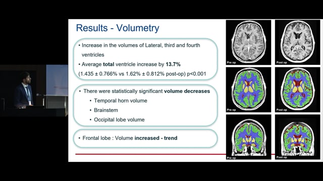 Quantitative Measurement of CSF and Brain volumes in Patients with Spontaneous Intracranial Hypotension using a Convolutional Ne