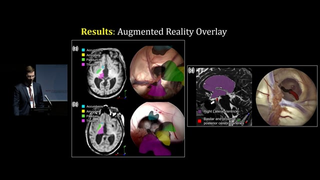 Ventricular endoscopy 2D video can be used for 3D reconstruction of anatomy – a novel technique for neuro-navigation - Ryan Lee