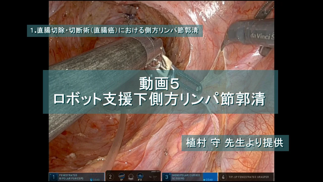 ロボット支援下側方リンパ節郭清 | 動画ライブラリ | 科研製薬 医療