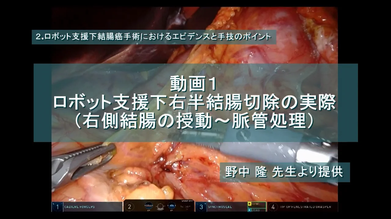 一人で難なくこなすための ロボット支援下結腸手術 一人で難なくこなすための ロボット支援下結腸手術［Web動画付