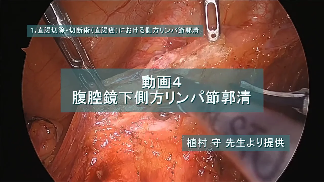 リンパ節郭清手技を究める 下部消化管編 リンパ節郭清手技を究める[下部消化管編]［Web動画付］ (新DS