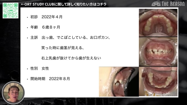 第24回 6歳児のガミースマイルと先天性欠損を伴う上顎前突・開咬症例