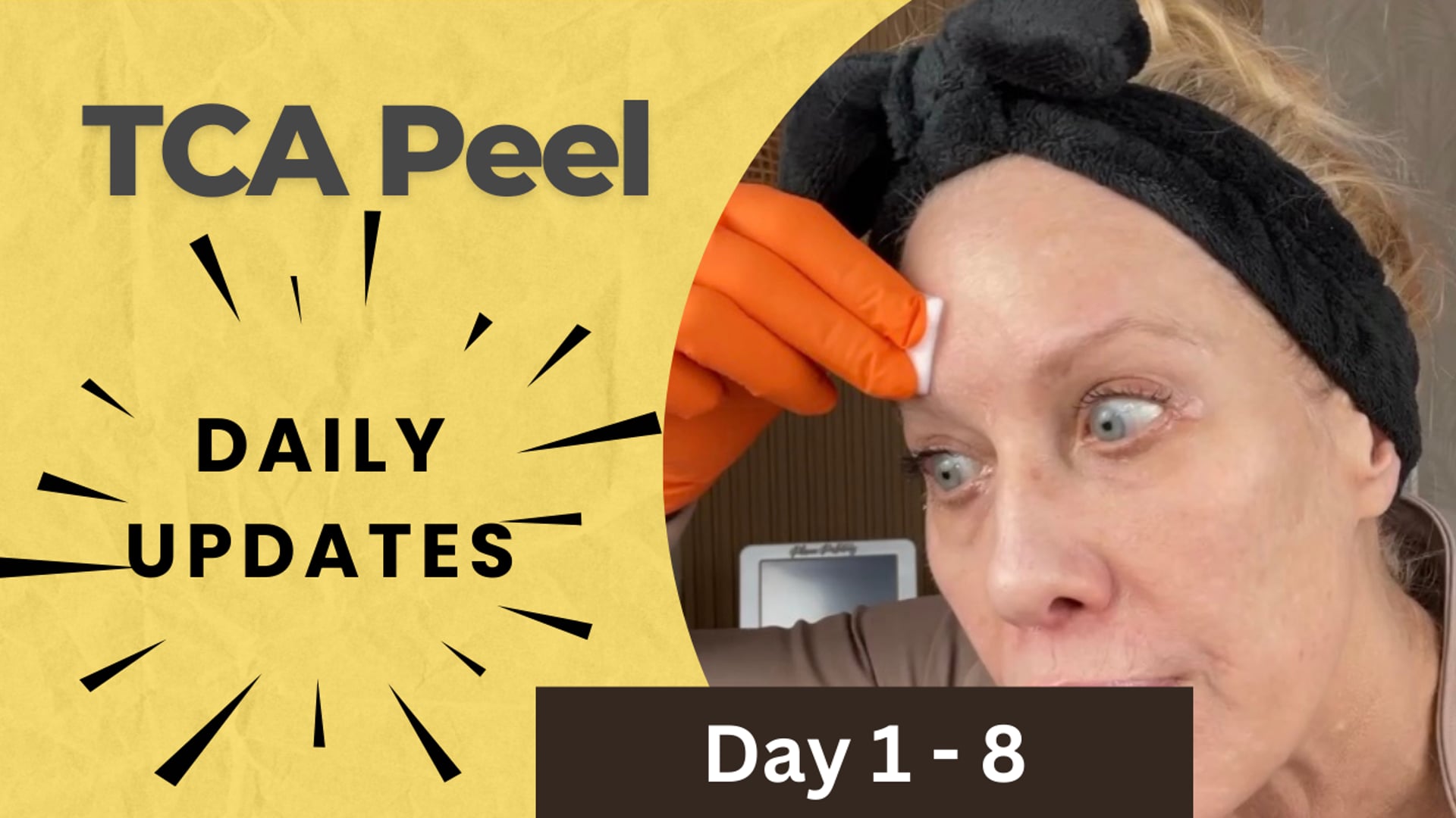 TCA Peel Update Day 1-8