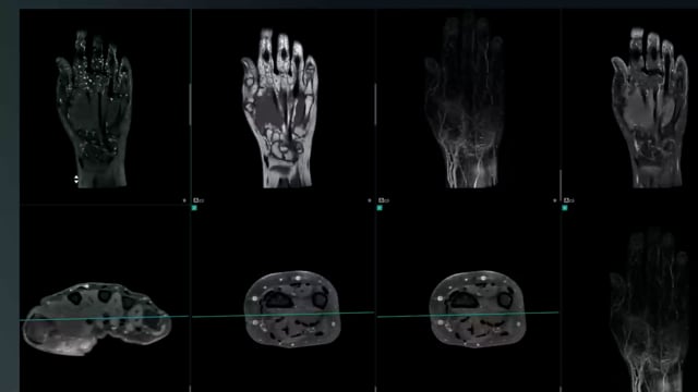 accessory muscle hand