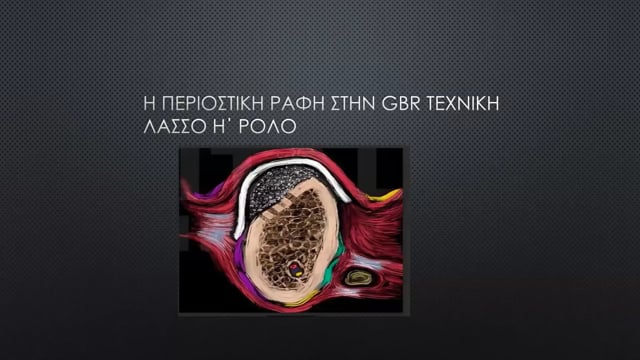 Η περιοστική ραφή στην GBR - Τεχνική Λάσσο ή Ρολό.
