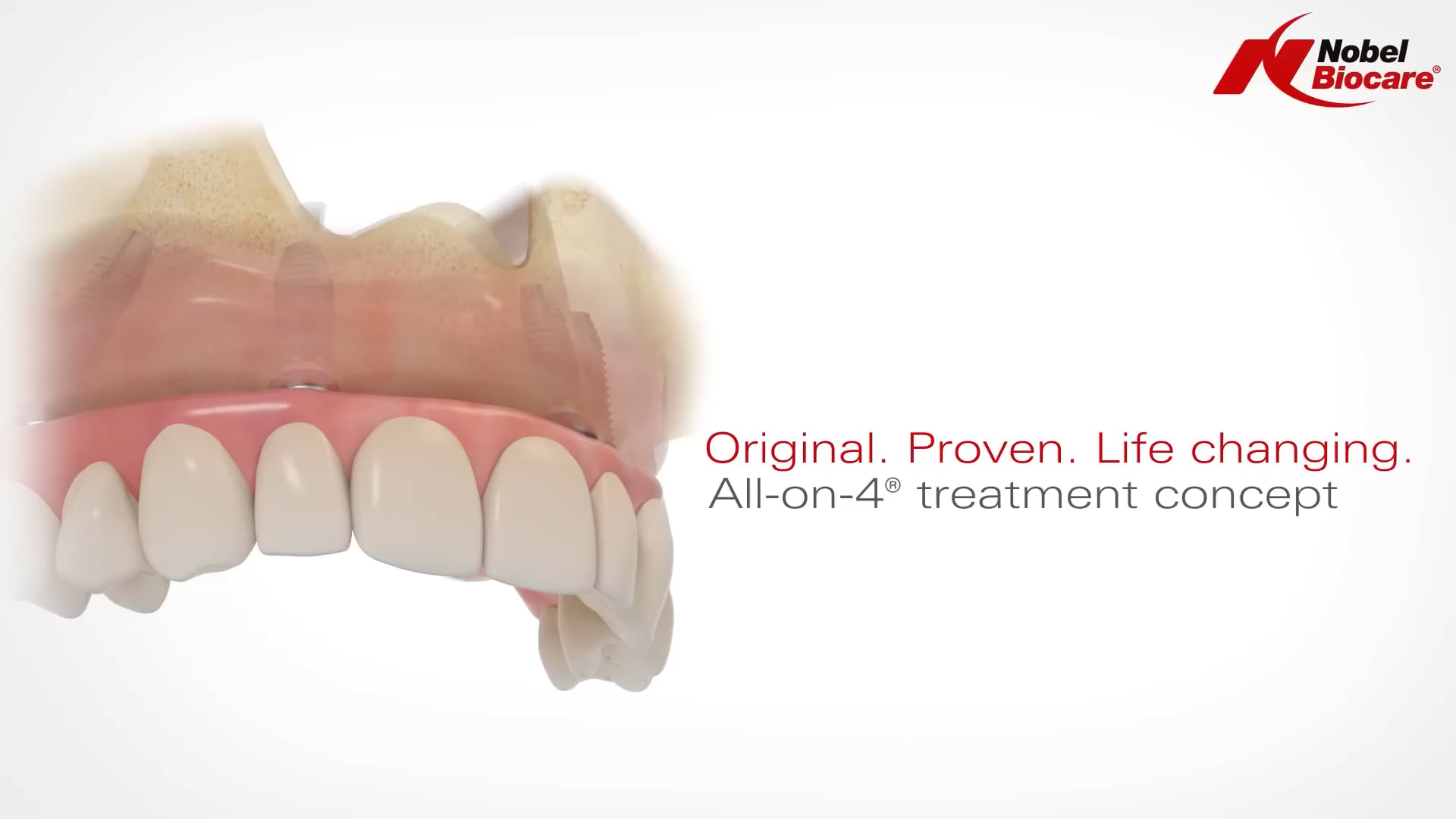 All-on-4® treatment concept (Nobel Biocare)