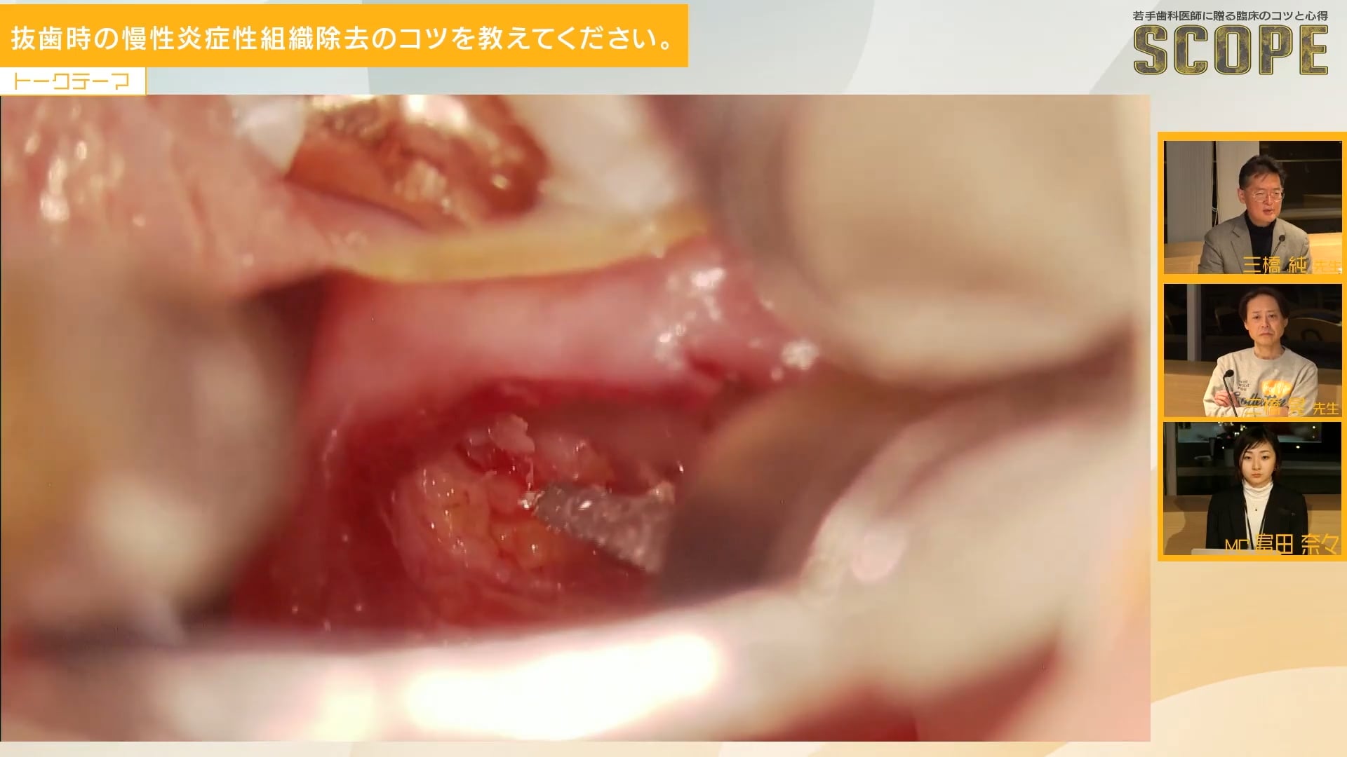 抜歯時の慢性炎症性組織除去のコツを教えてください。