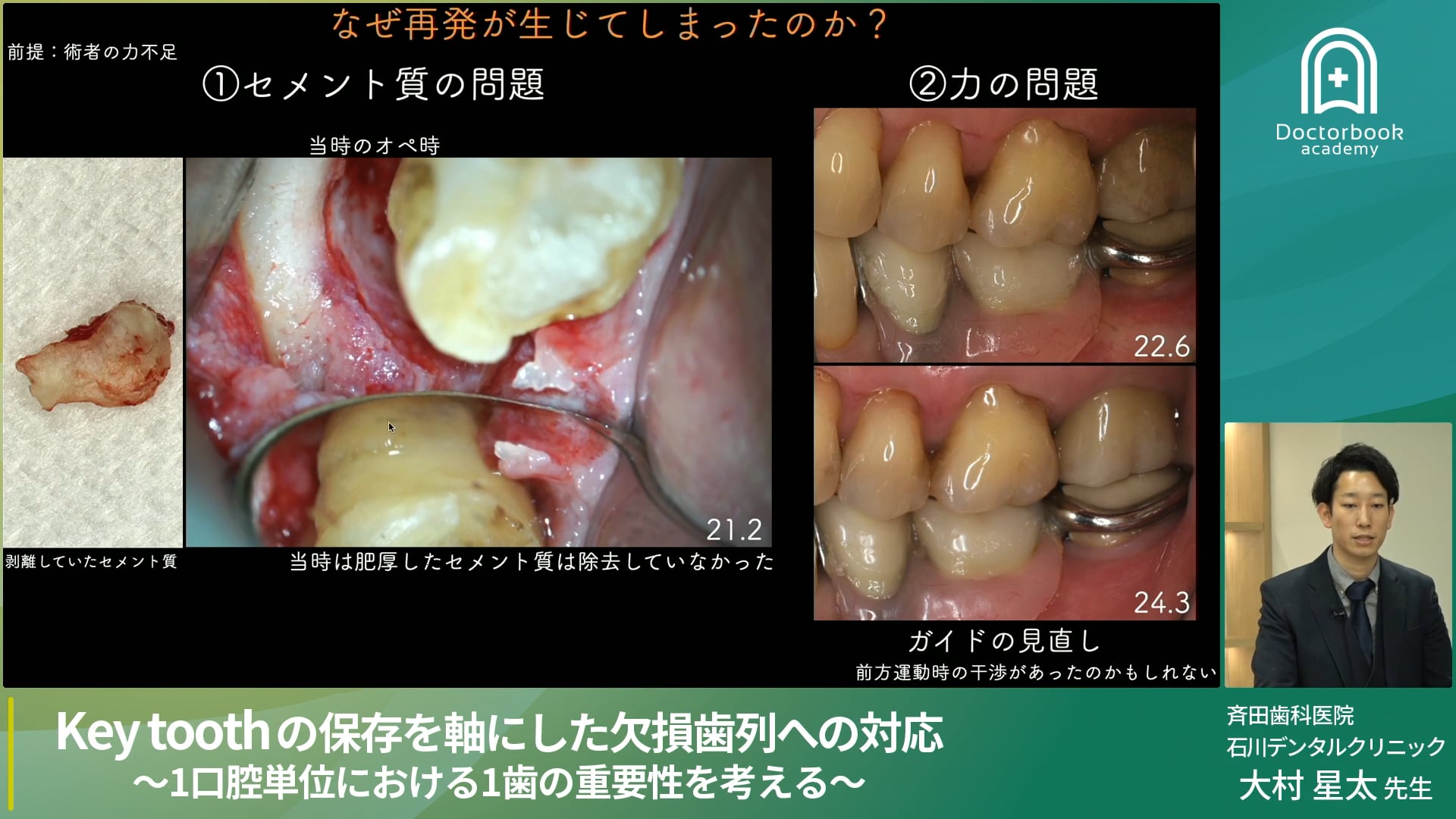 Key toothの保存を軸にした欠損歯列への対応〜1口腔単位における1歯の重要性を考える〜