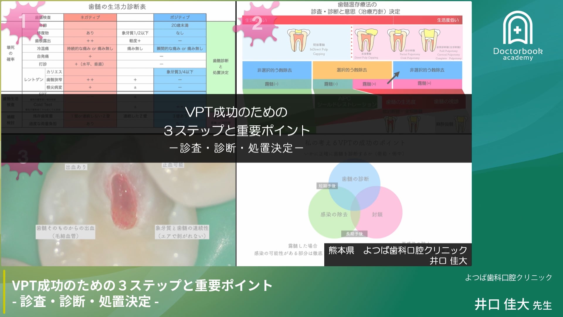 VPT成功のための3ステップと重要ポイント -診査・診断・処置決定-