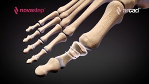Agrafes compressive en nitinol Arcad®