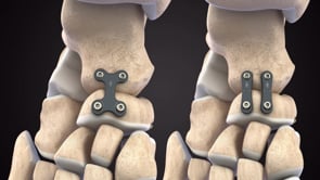 Plaque Fusion Airlock® – Presslock®: Arthrodèse talo-naviculaire