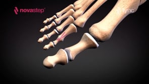 Lync® surgical technique