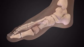 Correction d’un Hallux valgus – vis PECA